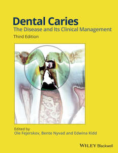 Dental Caries : The Disease and its Clinical Management