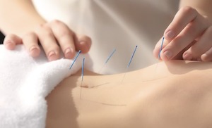 Acupuncture Services - Physio Movement