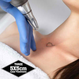 Three Treatments - up to 5cm x 5cm Laser Tattoo Removal - Save $30